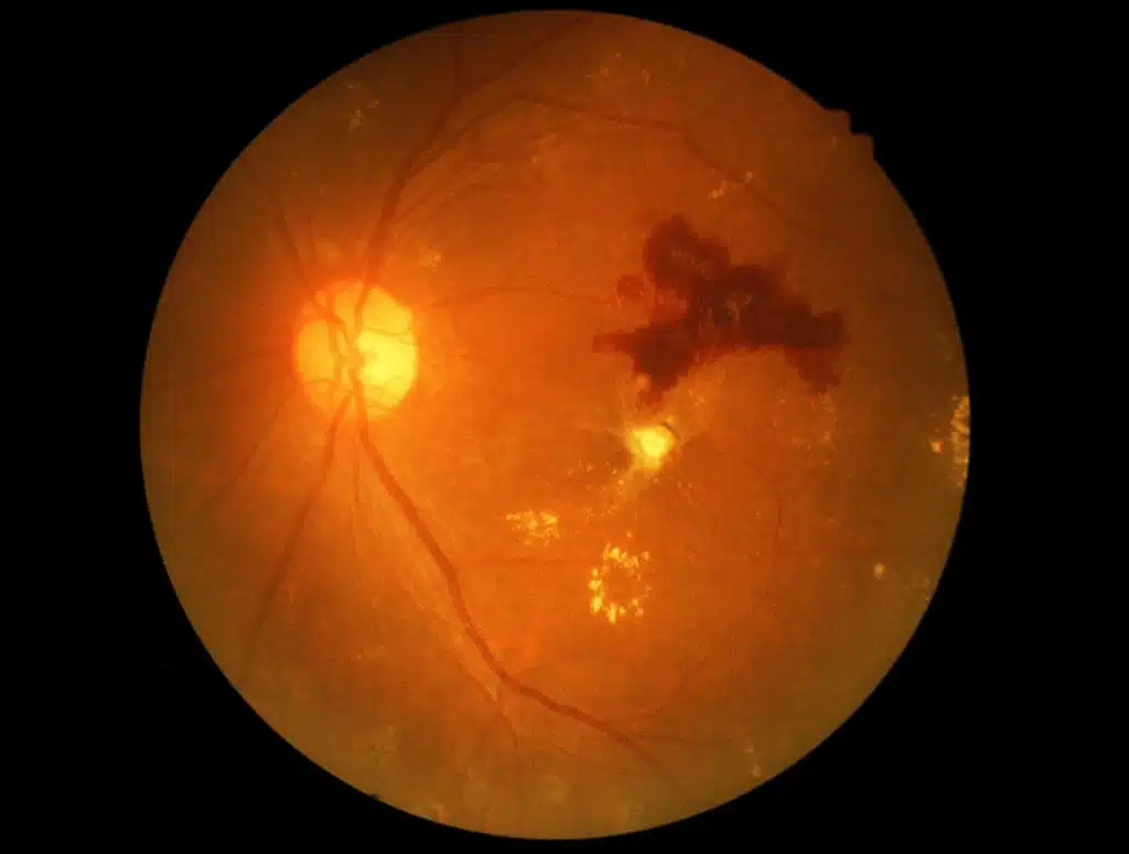 diabetic retinophaty