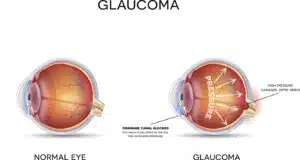 Glaucoma Tests - Advanced Sight Center - Missouri